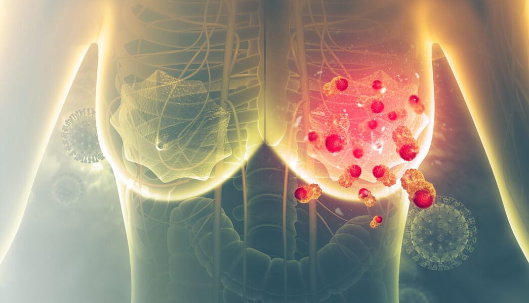 Los resultados de dicha investigación cambiarían drásticamente la forma de tratar el temido cáncer de mama.