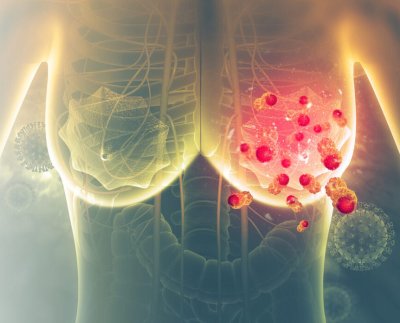 Los resultados de dicha investigación cambiarían drásticamente la forma de tratar el temido cáncer de mama.