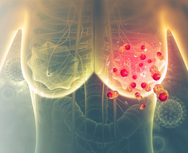 Los resultados de dicha investigación cambiarían drásticamente la forma de tratar el temido cáncer de mama.