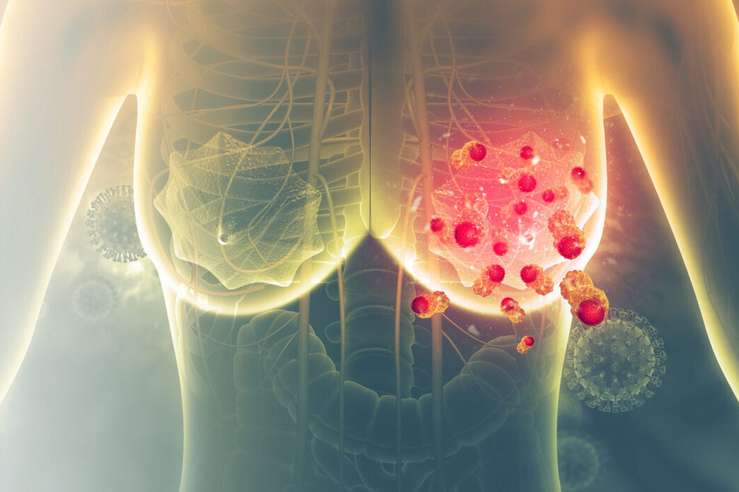 Los resultados de dicha investigación cambiarían drásticamente la forma de tratar el temido cáncer de mama.