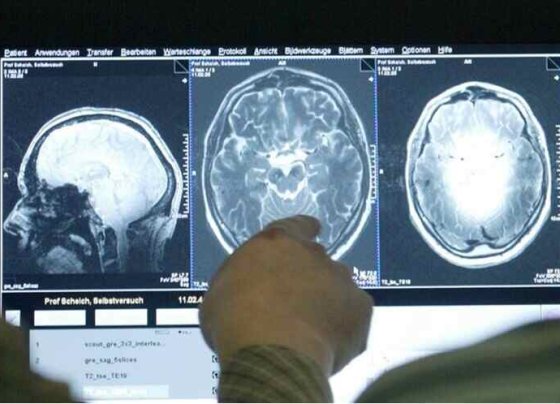 La esclerosis múltiple es una enfermedad en la que el sistema inmunológico ataca por equivocación el cerebro y la médula espinal.