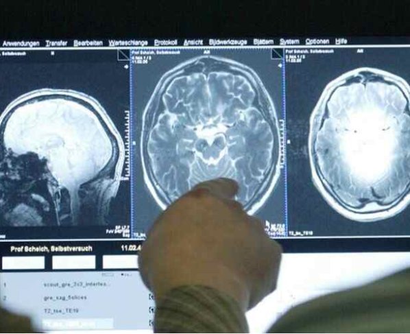 La esclerosis múltiple es una enfermedad en la que el sistema inmunológico ataca por equivocación el cerebro y la médula espinal.