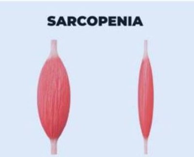 es la pérdida de masa muscular y fuerza esquelética como resultado del envejecimiento.