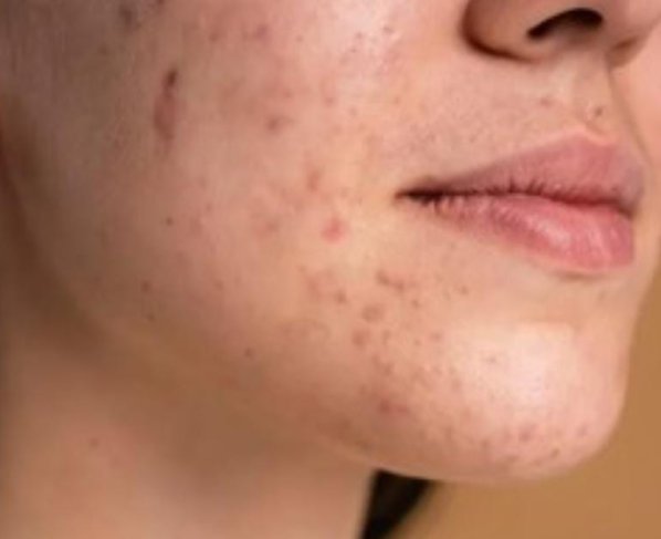 El video fue compartido por se hizo viral y llamó la atención de los usuarios al mostrar la hinchazón arriba de sus labios después de contraer una infección por estafilococos.