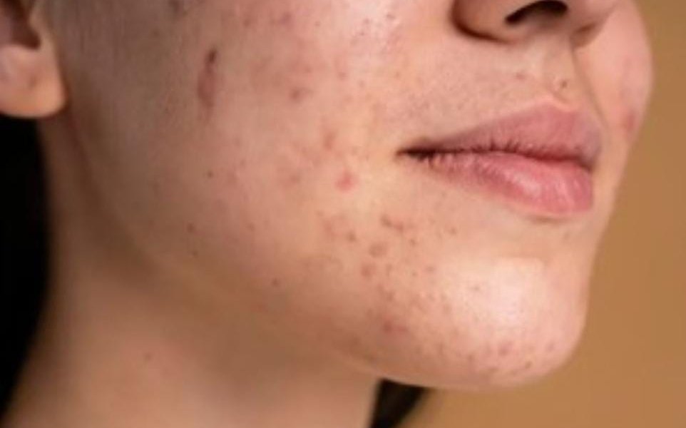 El video fue compartido por se hizo viral y llamó la atención de los usuarios al mostrar la hinchazón arriba de sus labios después de contraer una infección por estafilococos.