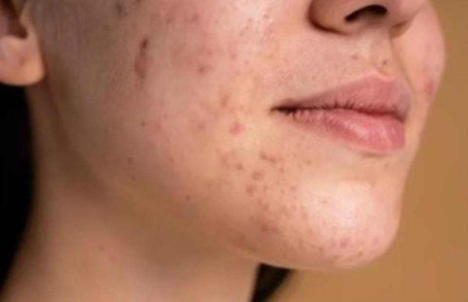 El video fue compartido por se hizo viral y llamó la atención de los usuarios al mostrar la hinchazón arriba de sus labios después de contraer una infección por estafilococos.