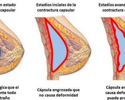 En ocasiones, los trasplantes mamarios pueden tener complicaciones y los médicos se ven en la obligación de tomar medidas correctivas. La Doctora Maripili Marteló explica en detalle esta situación.
