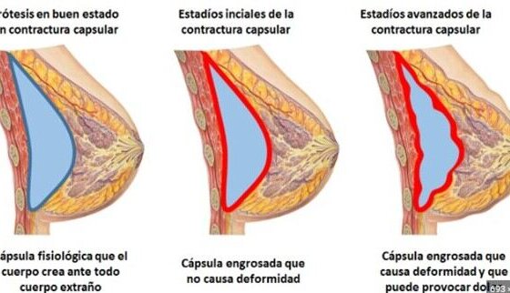 En ocasiones, los trasplantes mamarios pueden tener complicaciones y los médicos se ven en la obligación de tomar medidas correctivas. La Doctora Maripili Marteló explica en detalle esta situación.