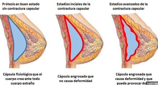 En ocasiones, los trasplantes mamarios pueden tener complicaciones y los médicos se ven en la obligación de tomar medidas correctivas. La Doctora Maripili Marteló explica en detalle esta situación.