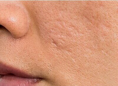 La verdad sobre las cicatrices en la piel es que necesitamos escuchar a los especialistas, los médicos tienen las respuestas a los problemas de la piel, en este caso las cicatrices que puedan quedar de operaciones o accidentes.