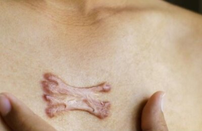 La realidad sobre la cicatriz del Quiloide es revelada por la doctora Maripili Marteló,quien explicó que es una cicatriz engrosada y elevada.