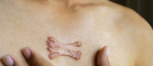 La realidad sobre la cicatriz del Quiloide es revelada por la doctora Maripili Marteló,quien explicó que es una cicatriz engrosada y elevada.