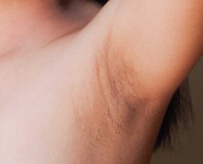 Manchas en las axilas y sus causas. Responden a varios factores que debemos considerar: irritación en la piel, una mala depilación, cambios hormonales y piel sensible.