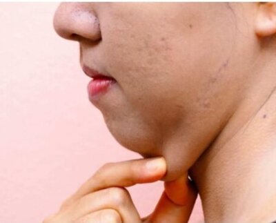 El mito de la papada. La papada o doble mentón o cuello de ganso hace referencia a un cuello con volumen excesivo debajo del mentón y la mandíbula.