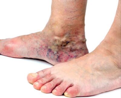 El pie diabético es una alteración clínica de base etiopatogénica neuropática e inducida por la hiperglucemia mantenida