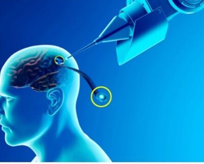 implantes cerebrales
