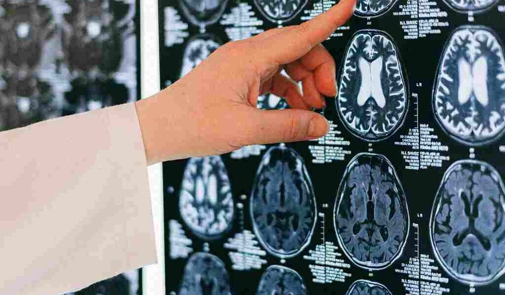 cerebro