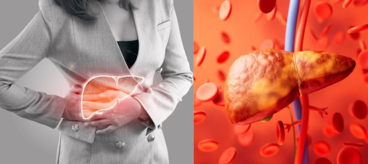 ¿Cuáles son los primeros síntomas del hígado graso? Expertos explican y dicen qué alimentos se deben evitar